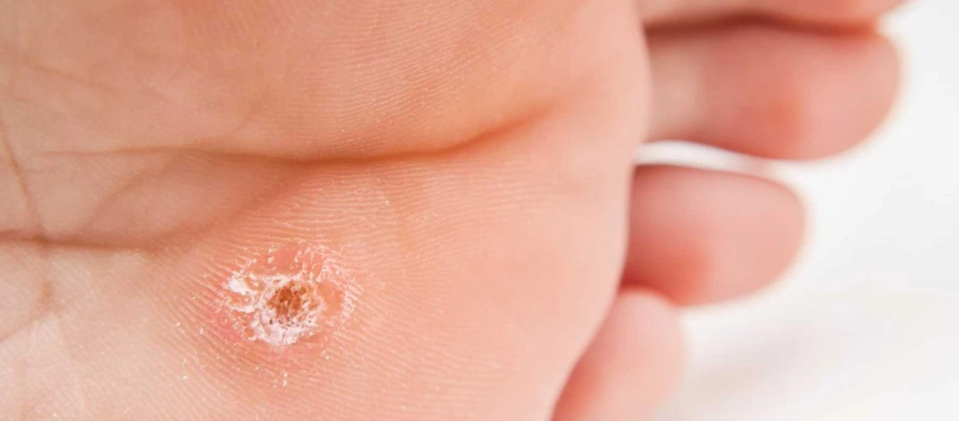 Πείτε «αντίο» σε κονδυλώματα και μυρμηγκιές με υλικά που έχετε σπίτι